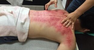 Gua Sha: La Tecnica Cinese per Sciogliere Tensioni e Drenare Tossine