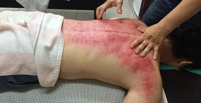 Gua Sha: La Tecnica Cinese per Sciogliere Tensioni e Drenare Tossine