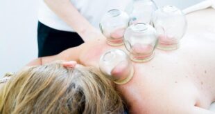 Coppettazione (Cupping): La Terapia a Ventosa per Muscoli e Dolore