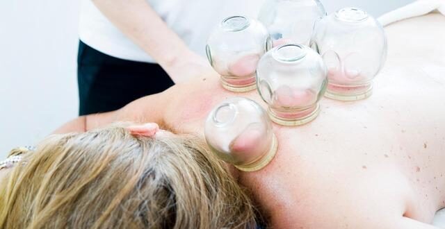Coppettazione (Cupping): La Terapia a Ventosa per Muscoli e Dolore